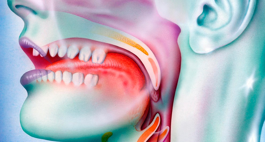 Что такое кандидоз полости рта?